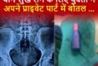 Surgery for a girl : दिल्ली में यौन जिज्ञासा में फंसी बोतल, युवती की सर्जरी कर निकाली गई ?