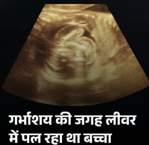 First case in india : लीवर में पलता मिला भ्रूण, भारत में पहला मामला, डॉक्टर भी रह गए हैरान ?