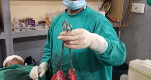 Intestinal cancer was found : स्वस्थ जीवन जीने वाले 36 वर्षीय व्यक्ति को अंतिम चरण का आंतों का कैंसर मिला ?