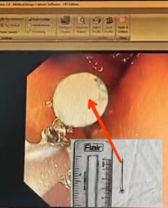 Safety pin : जीएसवीएम मेडिकल कॉलेज के डॉक्टरों ने 13 वर्षीय किशोरी के पेट से निकाली चार सेंटीमीटर की सेफ्टी पिन
