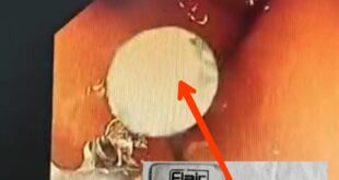 Safety pin : जीएसवीएम मेडिकल कॉलेज के डॉक्टरों ने 13 वर्षीय किशोरी के पेट से निकाली चार सेंटीमीटर की सेफ्टी पिन