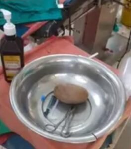 Successful surgery : बवासीर की सिकाई के दौरान मलद्वार में फंसा डेढ़ किलो का पत्थर, उर्सला अस्पताल में सफल सर्जरी