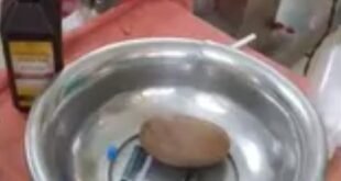 Successful surgery : बवासीर की सिकाई के दौरान मलद्वार में फंसा डेढ़ किलो का पत्थर, उर्सला अस्पताल में सफल सर्जरी